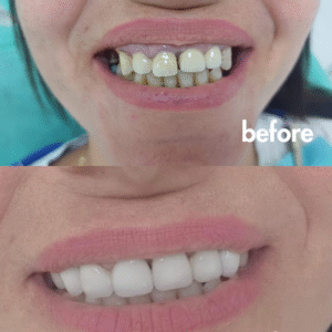 Beige Minimalist Beauty Before After Collage Instagram Post